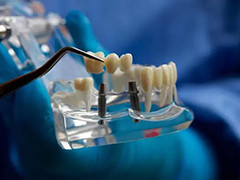 国家医保局对单颗常规种植牙医疗服务价格进行调控