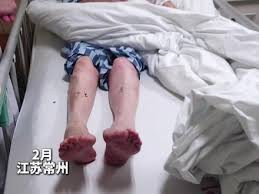 江苏常州 18岁小伙长时间卧床致深静脉血栓
