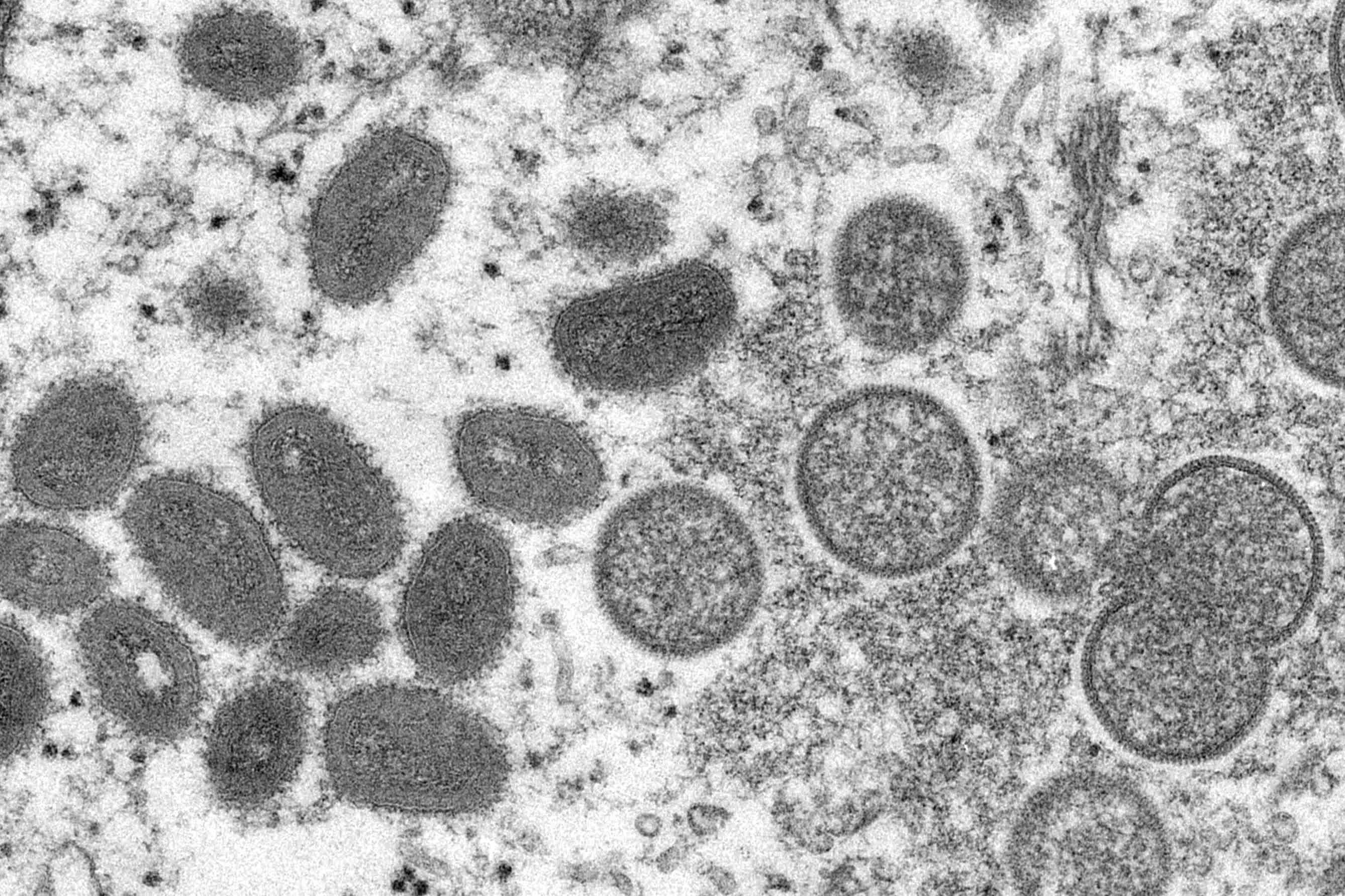 日本确诊一例猴痘病毒“分支lb”毒株感染病例
