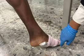 外籍旅客脚底藏毒 深圳海关当场截获