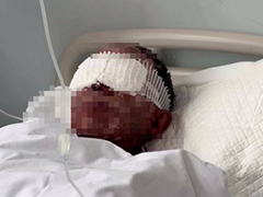 清理"未燃尽烟花爆竹"被炸伤双眼 安徽环卫人员来沪就医