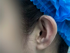 网红"精灵耳"整形致伤致残 暗藏医疗隐患